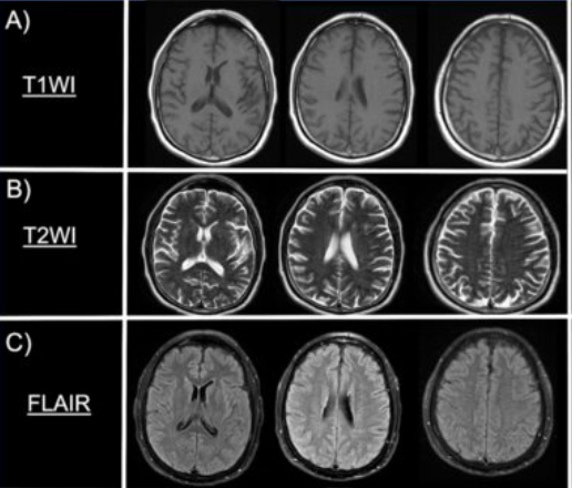 Figure 1. MRI of a patient with acute hypoglycemia that mimicked symptoms of acute ischemic stroke, but did not show the usual pathologies on the brain scan. (A) T1 weighted image. Note that the CSF, appearing dark in the ventricles and between the meninges (B) T2 weighted image. Note the CSF appearing bright. (C) FLAIR image. Note that the CSF no longer appears bright, but dark and the signal is less exaggerated.
